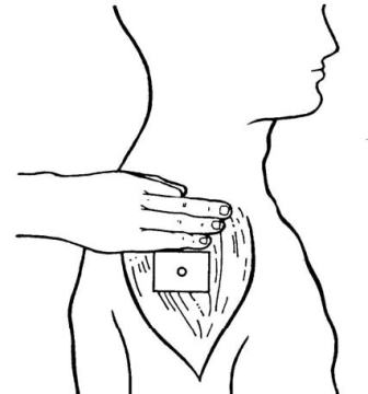 Location for upper arm injection. 