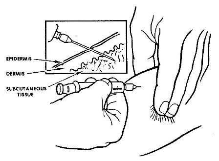  Insertion of needle during subcutaneous injection