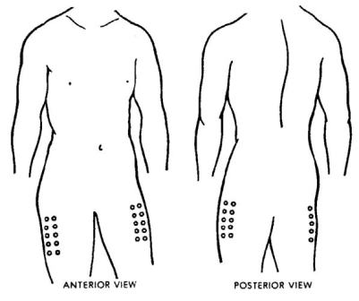 Injection sites: Vastus lateralis area, outer aspect of upper leg