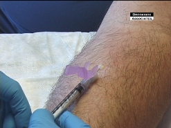 Intradermal injection