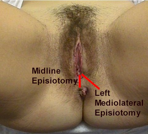Locations for episiotomy