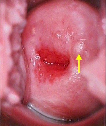 hpv cyst