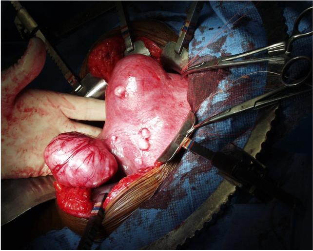 Fibroid Uterine Tumors