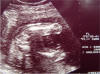 fetal femur