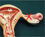 tubal ligation
