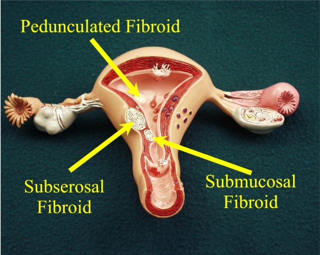 Model of fibroids