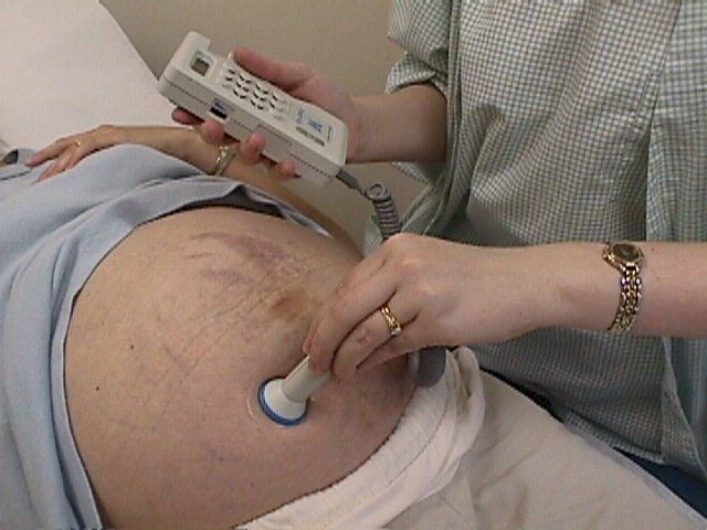 Listening to fetal heart tones with a doppler