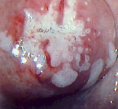 Colposcopy from above patient