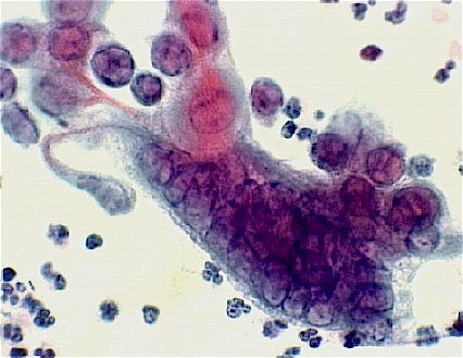 Herpes on Pap smear