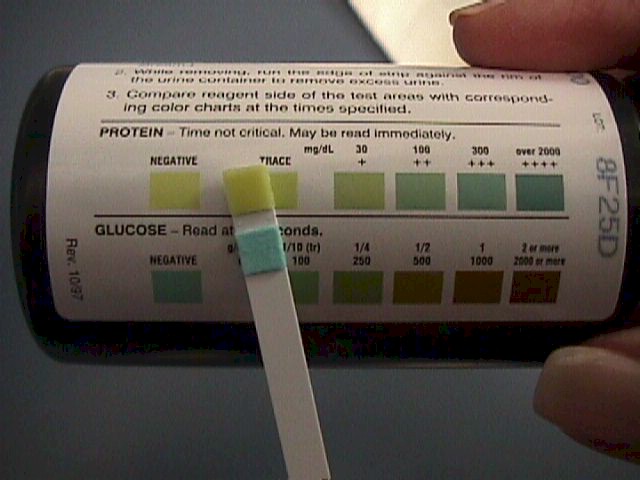 Urine dipstick testing
