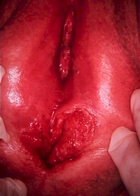 Invasive vulvar cancer