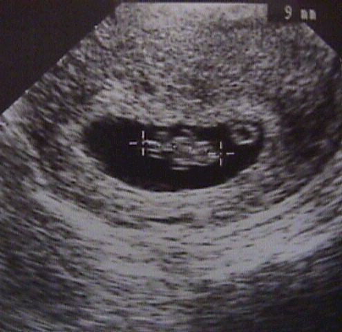 1st trimester ultrasound scan showing a fetal crown rump length
