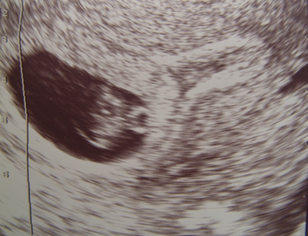Ultrasound image showing a gestational sac