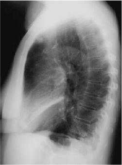 Right Middle Lobe Consolidation