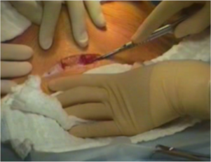 Cesarean Section Video