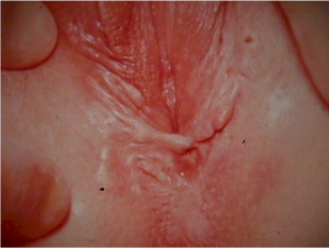 Vulva Biopsy Video