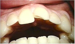 Chipped Tooth.jpg (11727 bytes)