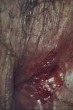 Rectal laceration