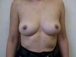 nspect the breasts for skin changes, symmetry, dimpling, retractions, visible bumps and nipple crusting