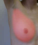 Breast tissue distribution