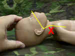 Hyperextension of the newborn neck compromising the airway