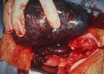 Torsioned Ovarian Cyst