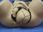 Fetal suture lines