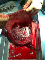 Inspect the placenta