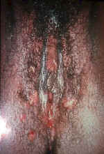 Condyloma Lata (Secondary Syphilis)