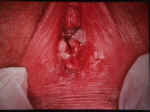 HPV of vulva