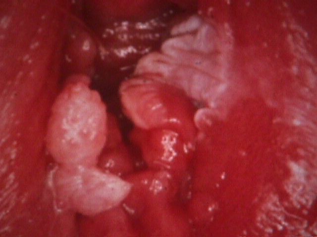 Vulvar Condyloma