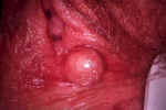 Inclusion cyst of the vulva