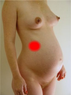 Appendicitis during 3rd trimester of pregnancy