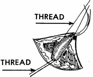 Figure 3-8. Thread under vein.