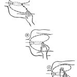 Figure 4-2. Locating the compression site for chest compressions.