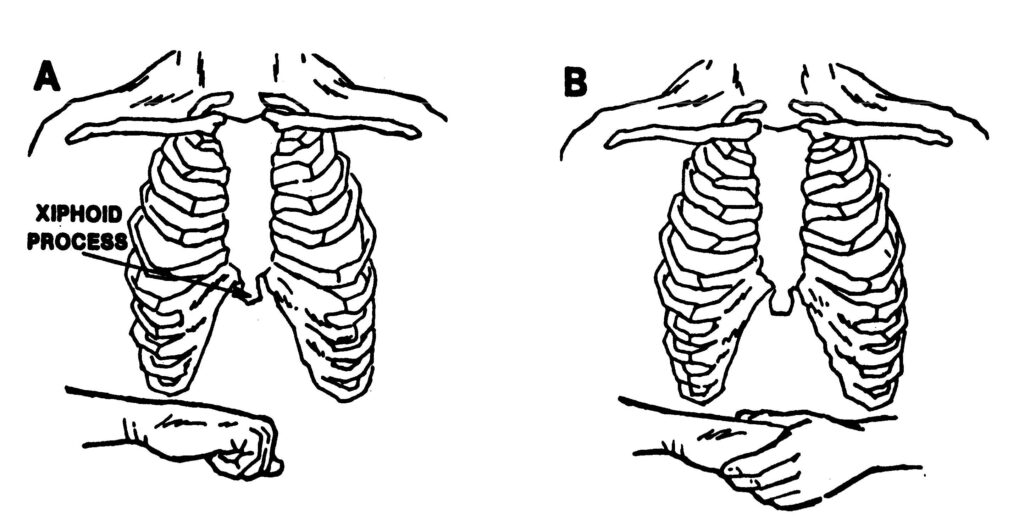Figure 5-2. Placement of hands for administering an abdominal thrust to a casualty standing or sitting.