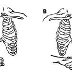 Figure 5-2. Placement of hands for administering an abdominal thrust to a casualty standing or sitting.