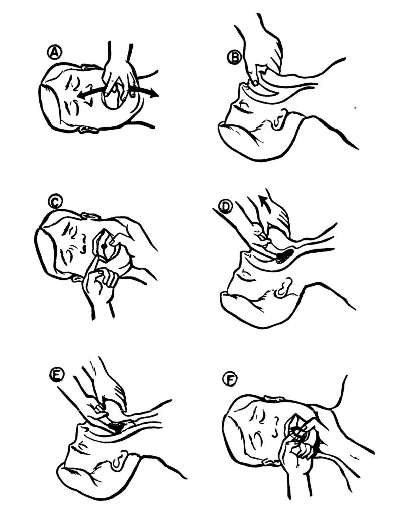 Figure 5-5. Performing a finger sweep on an unconscious casualty.