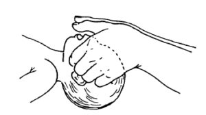 Figure 6-1. Performing a jaw -thrust on an infant.