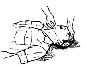 Figure 3-2. Opening the airway: head-tilt/chin-lift method.