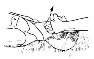Figure 3-3. Opening the airway: jaw-thrust method.