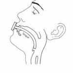 Figure 3-2. An oropharyngeal airway in place.