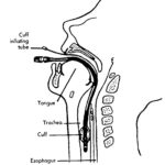 Figure 3-8. Endotracheal Tube in Position