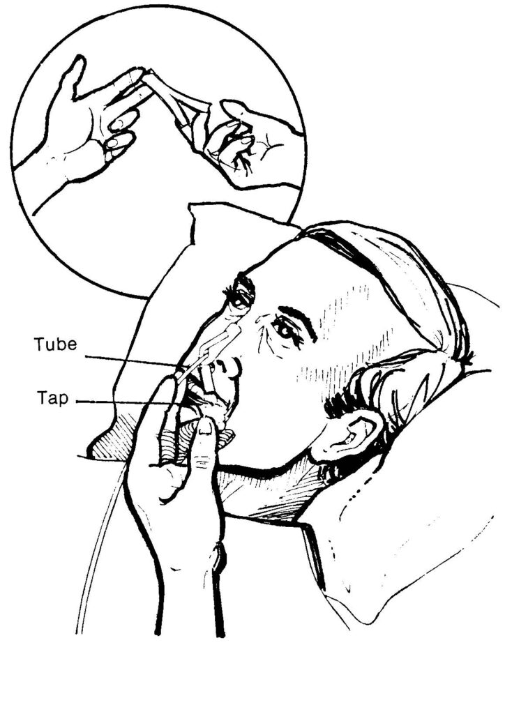 Figure 4-5. Applying tape to secure NG tube.