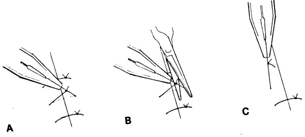 Figure 4-13 Removing suture from wound.