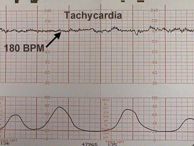 fetal heart tone monitor
