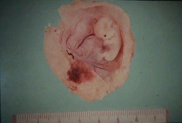 9-Week Spontaneous Abortion.