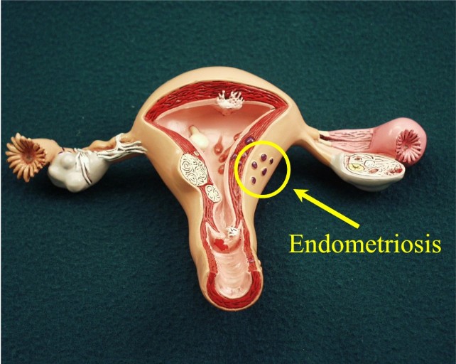 Endometriosis