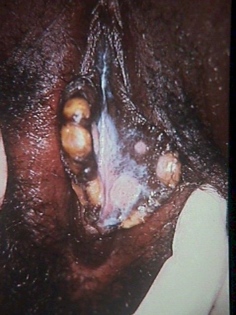 Condyloma Lata (Secondary Syphilis)