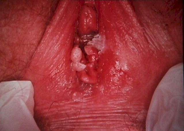 Vulva condyloma Humán papillómavírus fertőzés (nemi szervi)